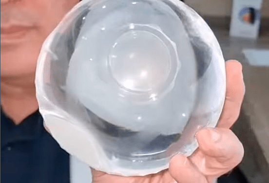 El balón gástrico: una solución segura y eficaz para perder peso